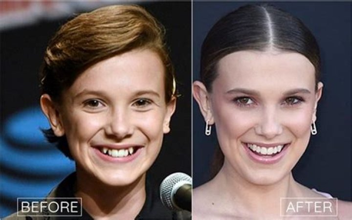 Did Millie Bobby Brown Really Get a Plastic Surgery