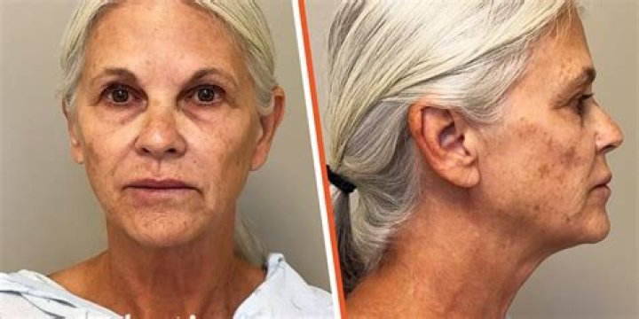 
Has Jane Fonda Had Plastic Surgery? Fans Speculate On ‘Facelift’ 